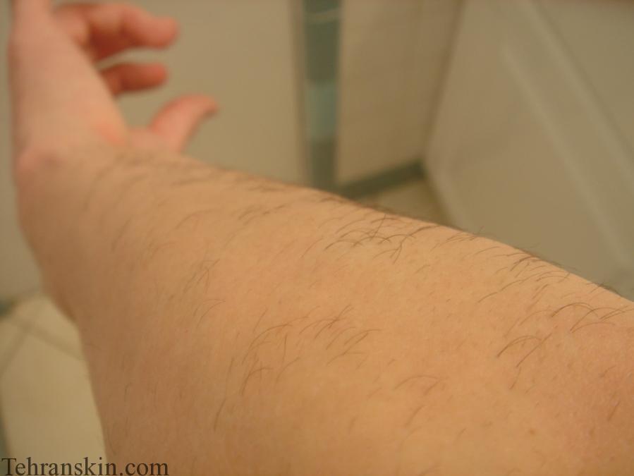 Image result for ‫لیزر موهای زائد دست مردان‬‎