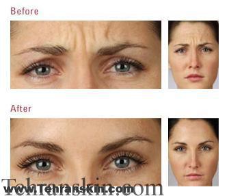 روش جایگزین بجای بوتاکس که چروکها را از بین می برد | تزریق بوتاکس، نتیجه، هزینه، عوارض