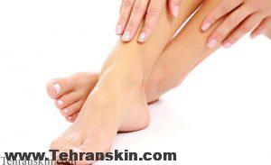 نتیجه تصویری برای رفع موهای زائد پا توسط لیزر