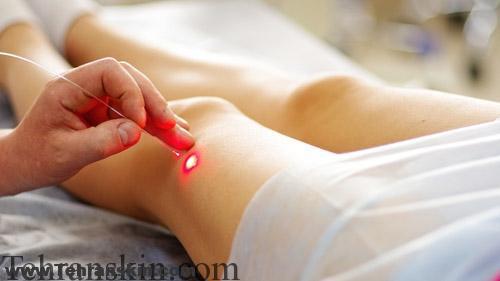 نتیجه تصویری برای لیزر خط بیکینی و لیزر برزیلی