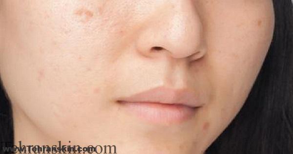 درمان جای جوش آکنه