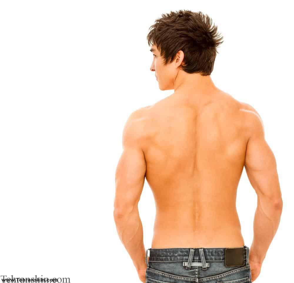 لیزر موی زائد بدن آقایان