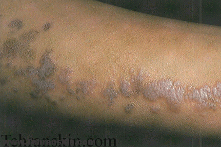 بیماری لیکن پلان