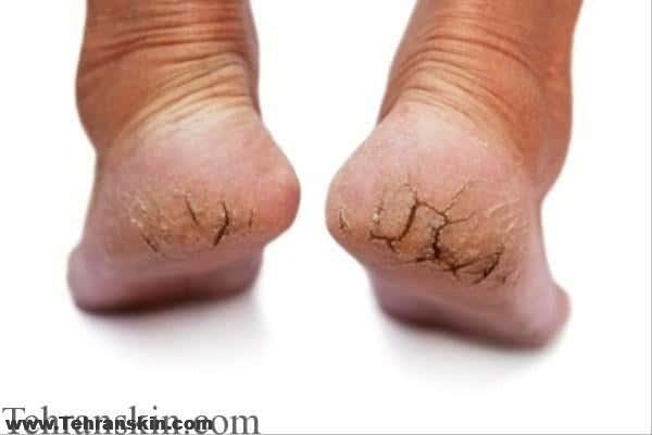 درمان ترک خوردگی کف پا