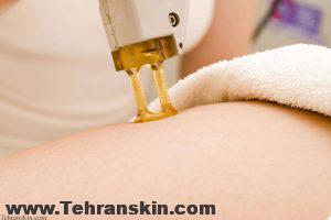 لیزر موهای زائد با دستگاه الکساندرایت و نکات مهمی که باید بدانید! Laser Hair Removal4 300x200 - لیزر موهای زائد با دستگاه الکساندرایت و نکات مهمی که باید بدانید!