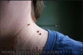 درمان خال گوشتی