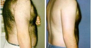 Image result for ‫لیزر درمانی برای موهای زائد مردان‬‎