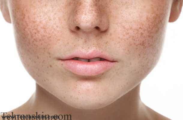 لکه های قهوه ای پوست