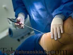 لیزر لیپوساکشن برای رفع چربی