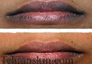 درمان تیرگی لبها