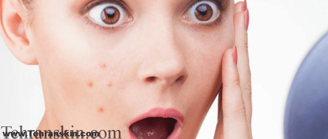 آکنه و موهای زائد چانه در زنان و مردان