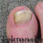 بیماری های ناخن