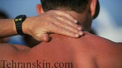 آفتاب سوختگی