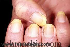 علل زرد شدن ناخن