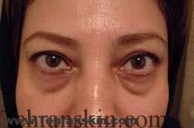 از بین بردن پف زیر چشم