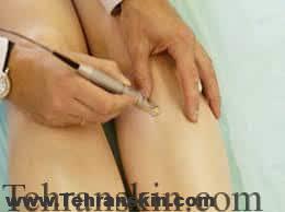 درمان با لیزر برای رگ های واریسی