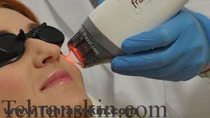 موارد استفاده از لیزر فرکشنال CO2