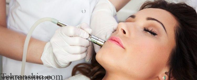 بهترین روش درمان مو های زائد