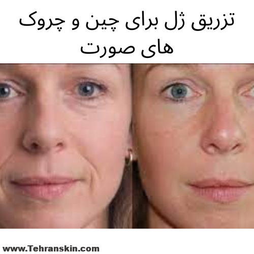 تزریق ژل برای گودی و چین و چروک ها