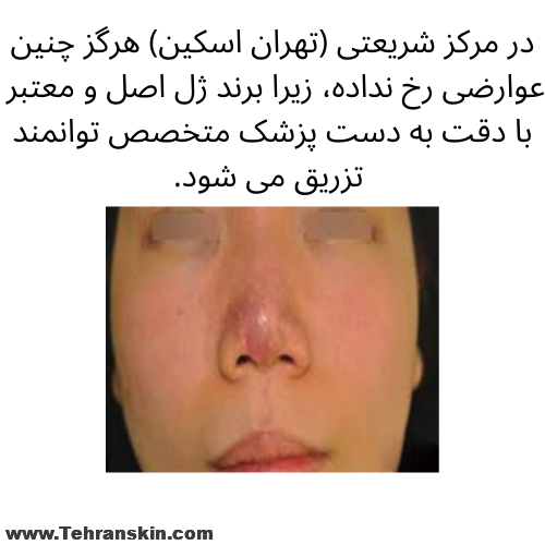عوارض ژل ارزان قیمت فیک
