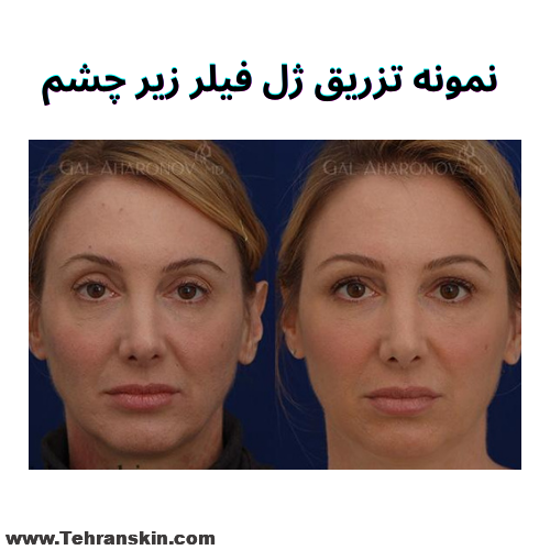 نمونه تزریق ژل زیر چشم
