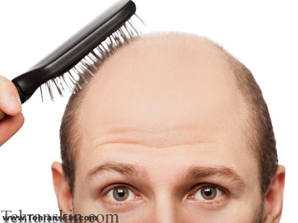 دلایل ریزش مو در زنان چیست؟ دلایل شوره سر و ریزش مو در مردان | کاشت مو