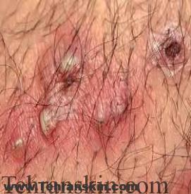 مو های فرو رفته در پوست