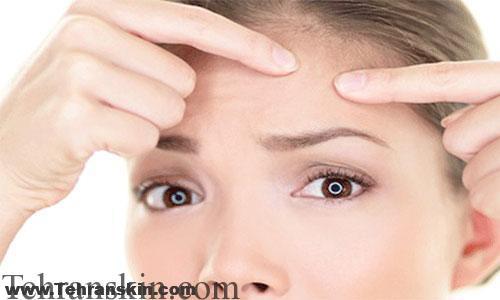 رفع جوش صورت