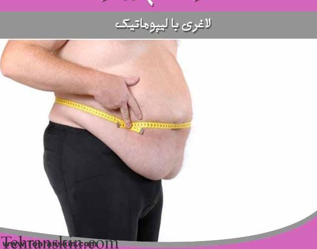لاغری-با-لیپوماتیک