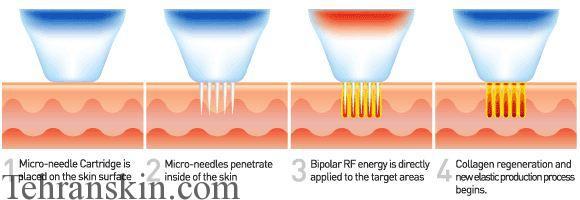طرز کار آر.اف.فرکشنال میکرونیدلینگ در درمان آکنه