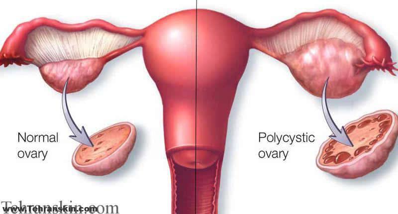 لیزر موهای زائد و سندروم تخمدان پلی کیستیک!