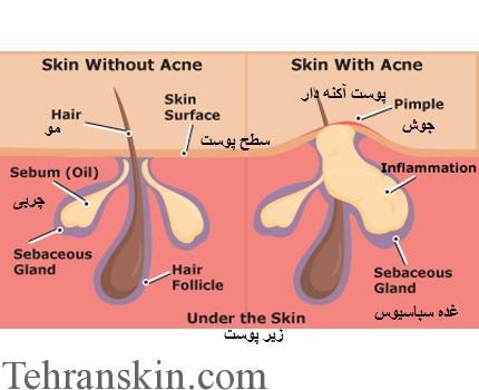 بهترین داروی کنونی درمان آکنه آکوتان؟ 