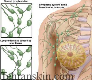بهترین لیزر-تورم لنفی پس از جراحی سرطان سینه