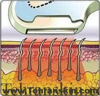 فتوترمولیز انتخابی در لیزر موهای زائد