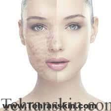 بهترین نکات آکوتان-آکنه