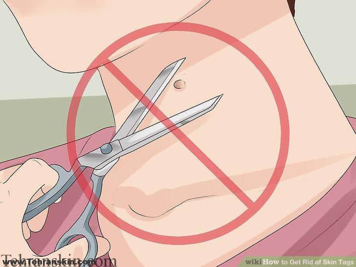 بهترین روش های درمان ضایعات پوستی زگیل خال گوشت اضافه به روش های کرایوسرجری میکروگراف موس لیزر فرکشنال و آر اف