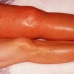 لیزردرمانی و تورم لنفی عروقی (لخته شدن خون)