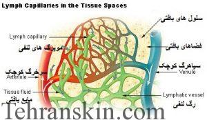 موثرترین لیزردرمانی و تورم لنفاوی