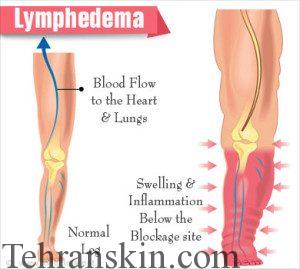 بهترین لیزردرمانی لنف ادما یا تورم لنفاوی 
