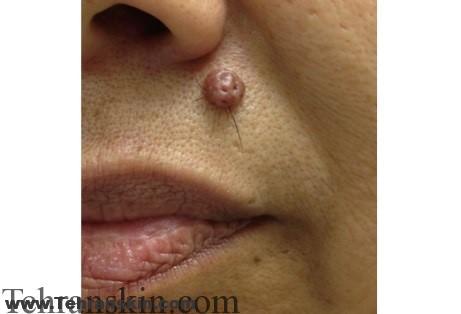 بهترین درمان انواع ضایعات پوستی