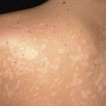 بهترین نکات لیزر درمانی و دارو