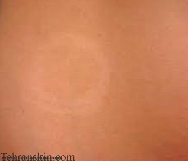 بهترین نکات لیزر درمانی و دارو