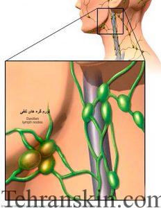 بهترین درمان لیزر-تورم لنفی زیربغل