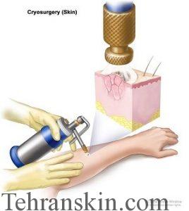 بهترین و موثرترین درمان ضایعات پوستی به روش کرایوسرجری