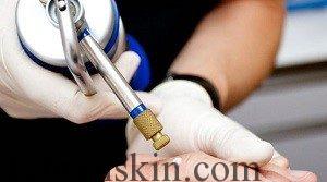 بهترین و موثرترین درمان ضایعات پوستی به روش کرایوسرجری زگیل