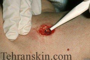 موثرترین روش درمان ضایعات پوستی کورتاژ یا کیورتاژ