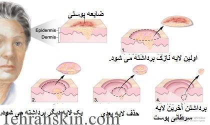 بهترین درمان ضایعات پوستی به روش میکروگراف موس Mohs