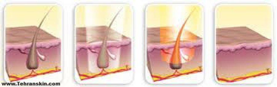 بهترین روش لیزر