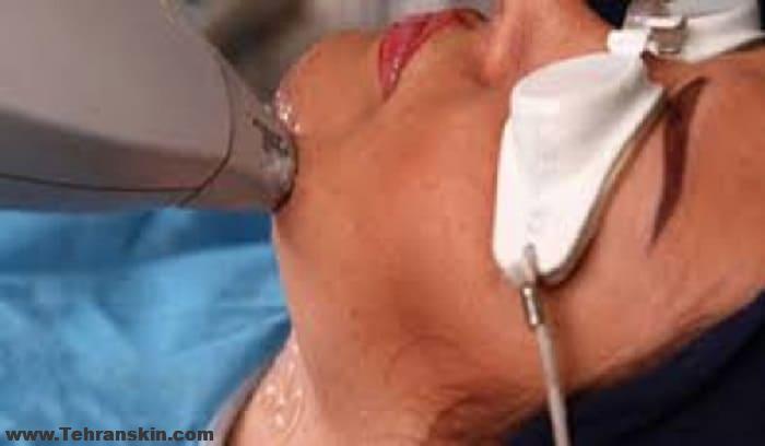 بهترین روش حذف مو های زائد