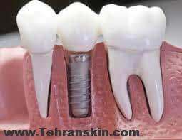 ایمپلنت دندان،جایگزین دندان های طبیعی شما!